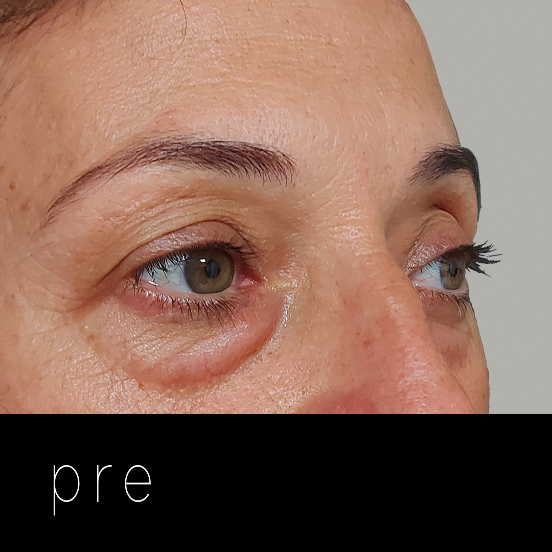 BLEFAROPLBLEFAROPLASTIA: laxitud septal.ASTIA pre