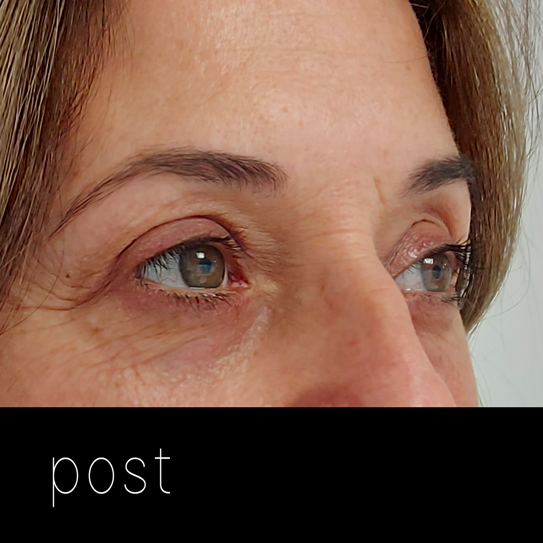 BLEFAROPLASTBLEFAROPLASTIA: tensado de párpado inferior + corrección de ptosis mecánica.IA post