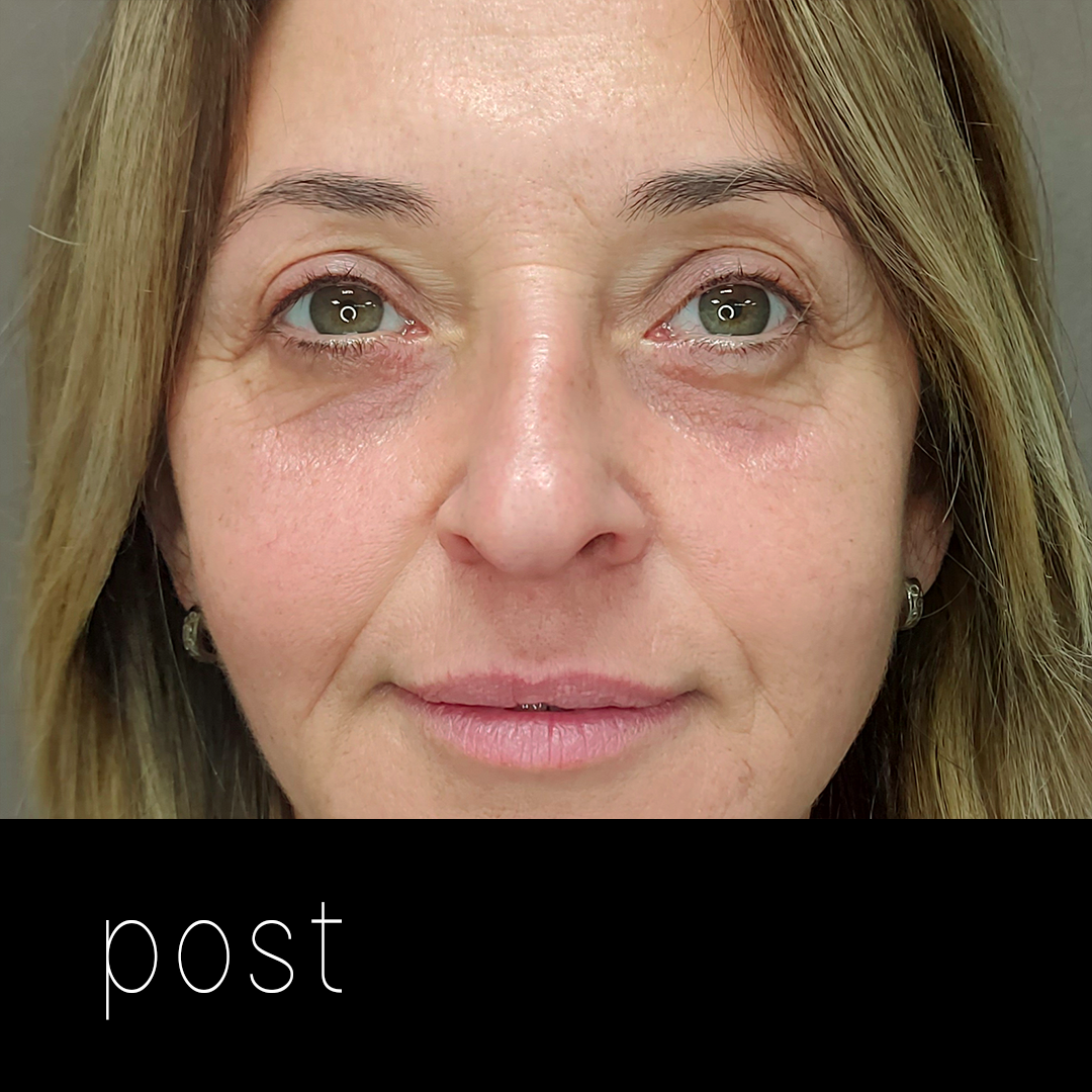 BLEFAROBLEFAROPLASTIA: tensado de párpado inferior + corrección de ptosis mecánica.PLASTIA post