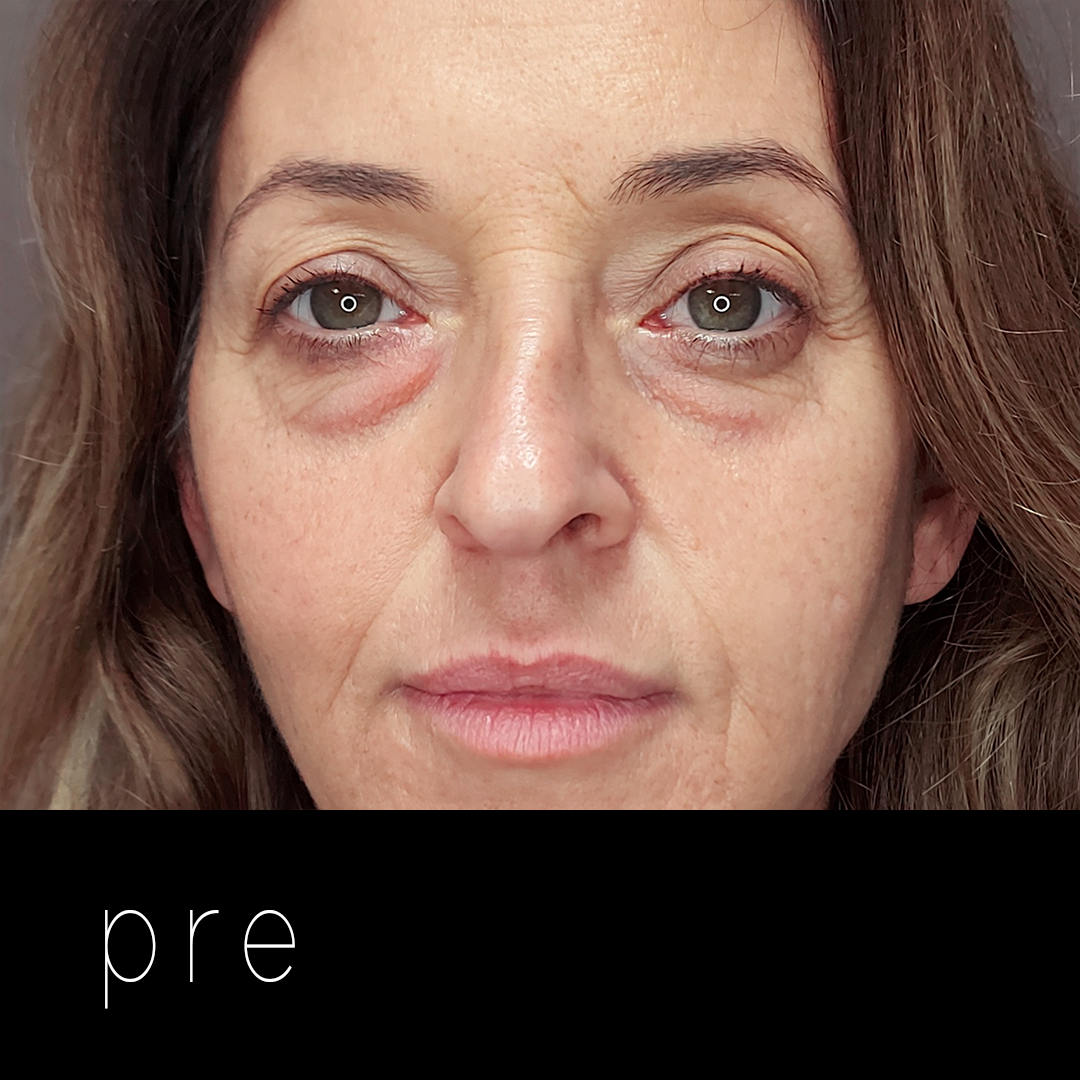 BLEFAROPLASTIA: laxitud septal.