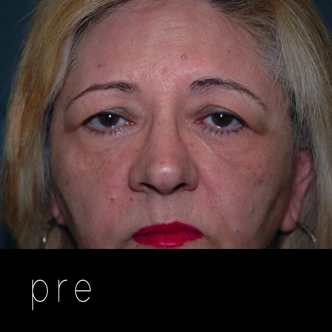BLEFAROPLASTIA: paciente con párpados caídos por exceso de piel (dermatocalasia) + ptosis de ceja + prolaspso de glándula lagrimal.