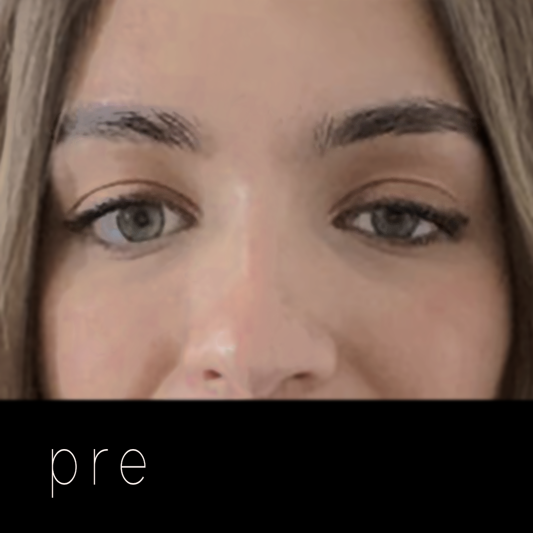 PTOSIS: párpado caído.