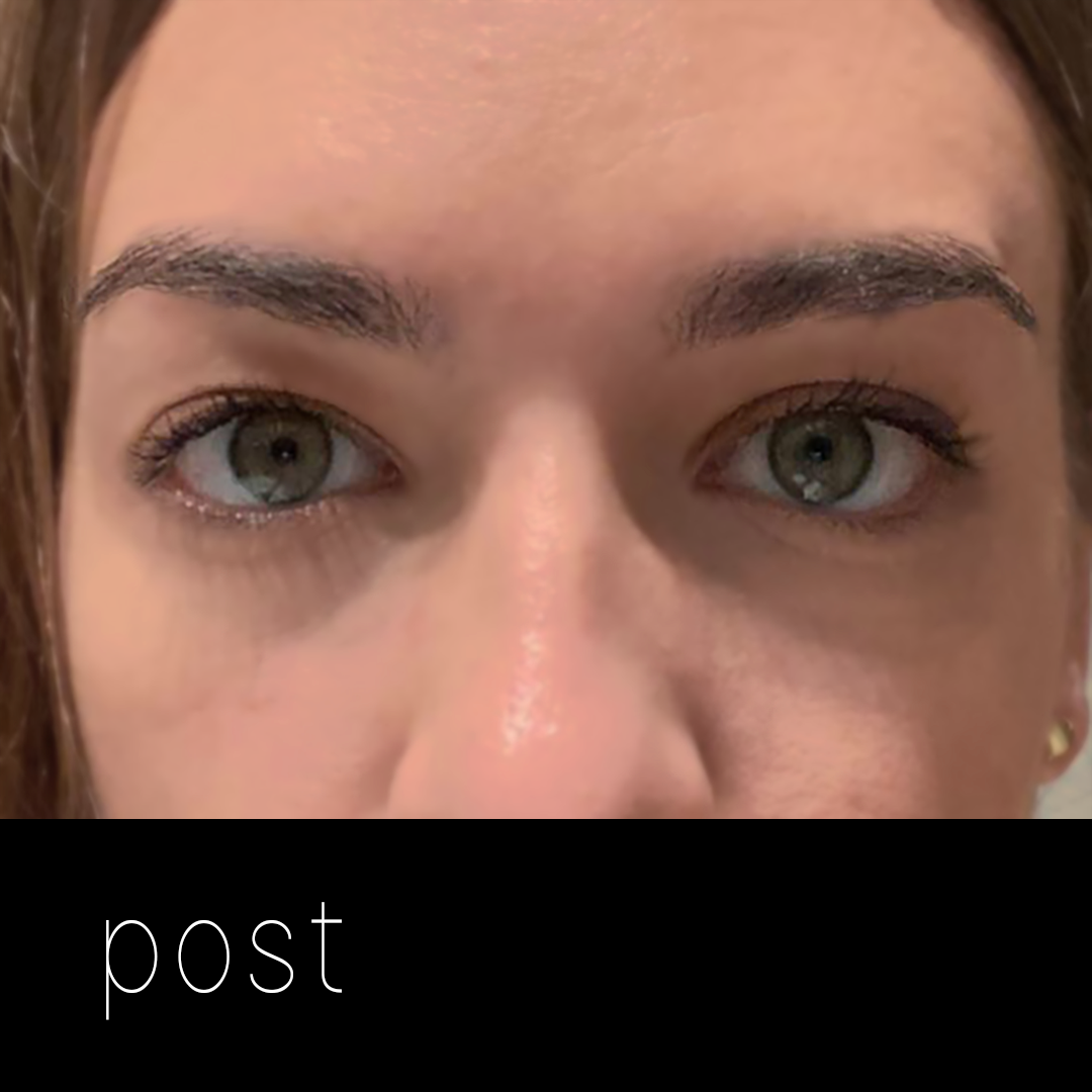 PTOSIS: elevación del párpado con cirugía vía posterior (transconjuntival) sin cicatriz.