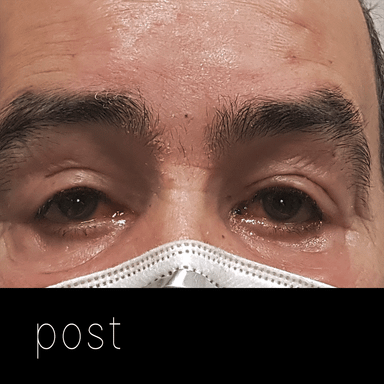 Cirugía de párpados