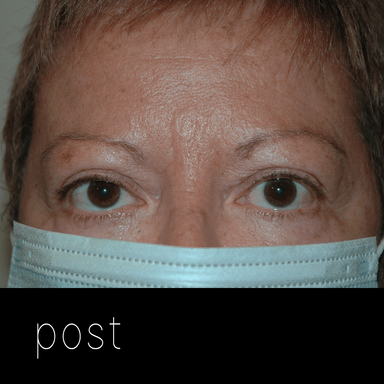 retracción palpebral